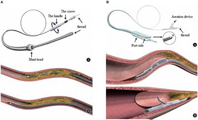 A Clinical Analysis of the Treatment of Chronic Coronary Artery Occlusion With Antegrade Dissection Reentry